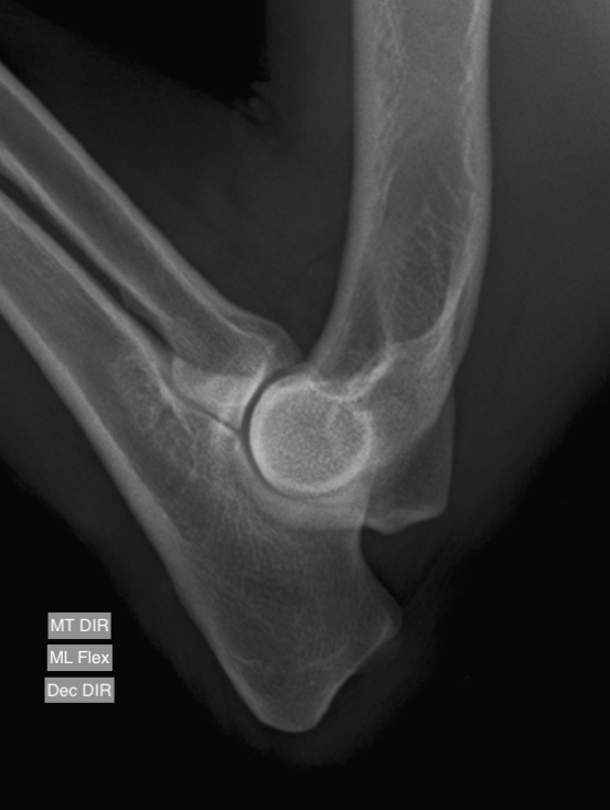 Cotovelo mediolateral flexionada