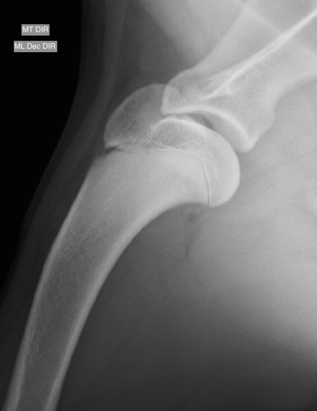 Ombro mediolateral