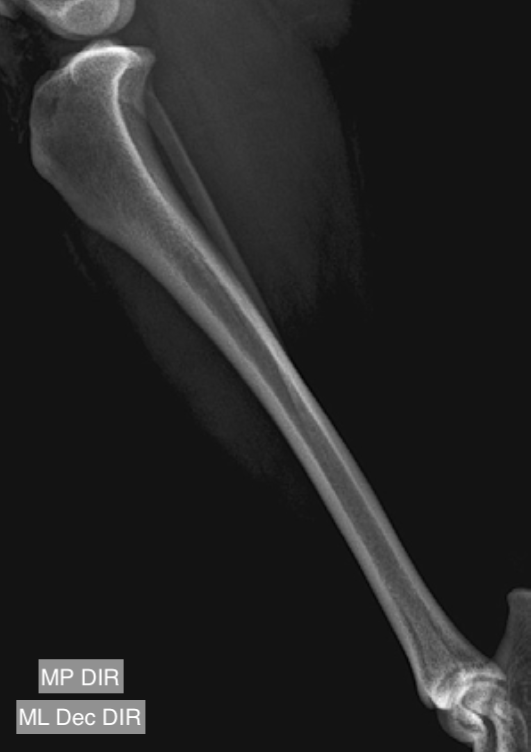 Tíbia mediolateral